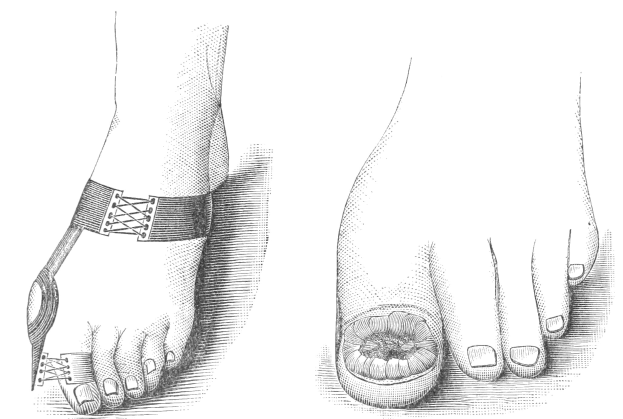 Schwarze und weiße Zeichnung eines Paares Füße, einer mit einem Verband und der andere mit einer Fraktur, mit Text, der den Verband als Behandlung anzeigt.